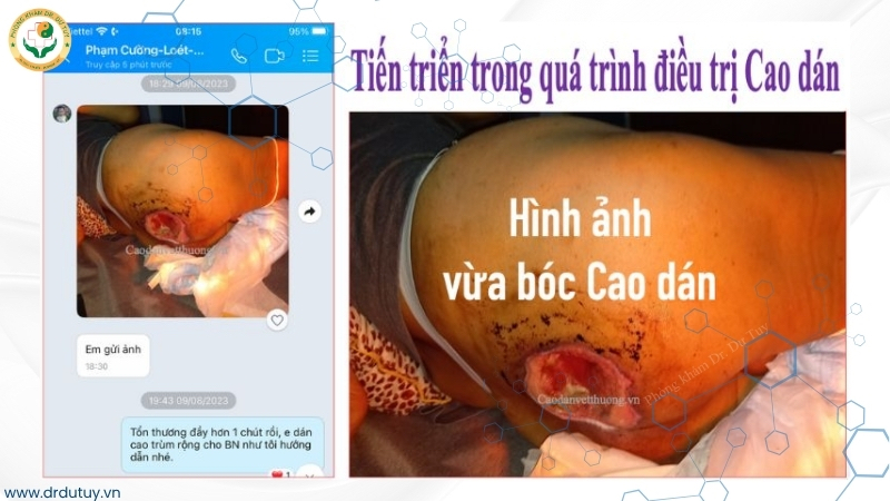 vết loét thu nhỏ dần sau điều trị