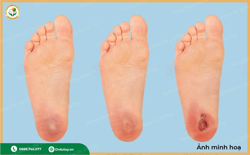 vết loét tiểu đường