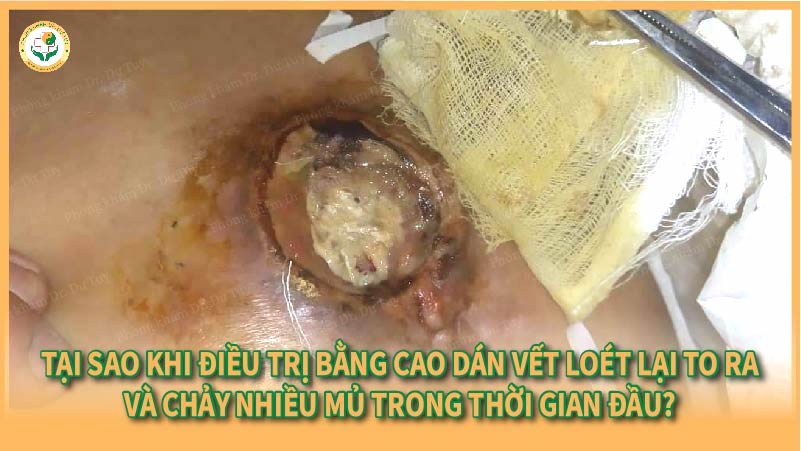 Tại sao khi điều trị bằng Cao Dán, vết loét lại to ra và chảy nhiều mủ trong thời gian đầu?