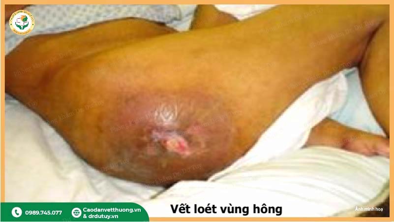 vết loét tỳ đè ở người sau tai biến