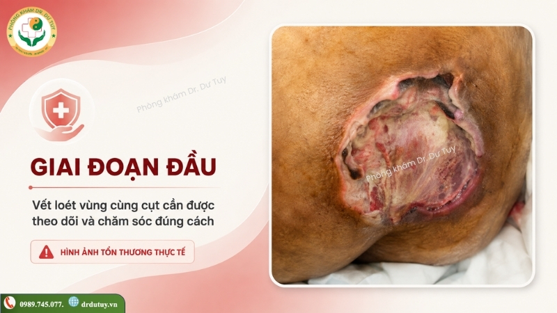vết loét vùng cùng cụt giai đoạn đầu