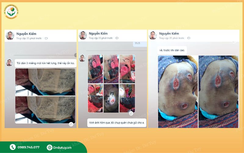 vết loét vùng cùng cụt