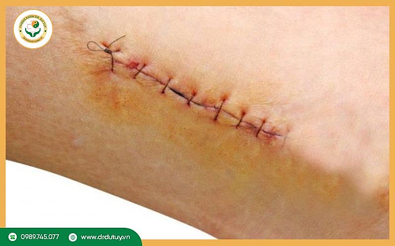 Vết mổ bị bầm tím có sao không?