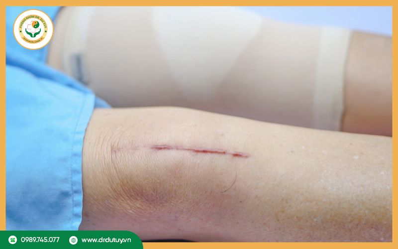 Vết mổ bị sưng cứng bên trong: Nguyên nhân và cách xử lý