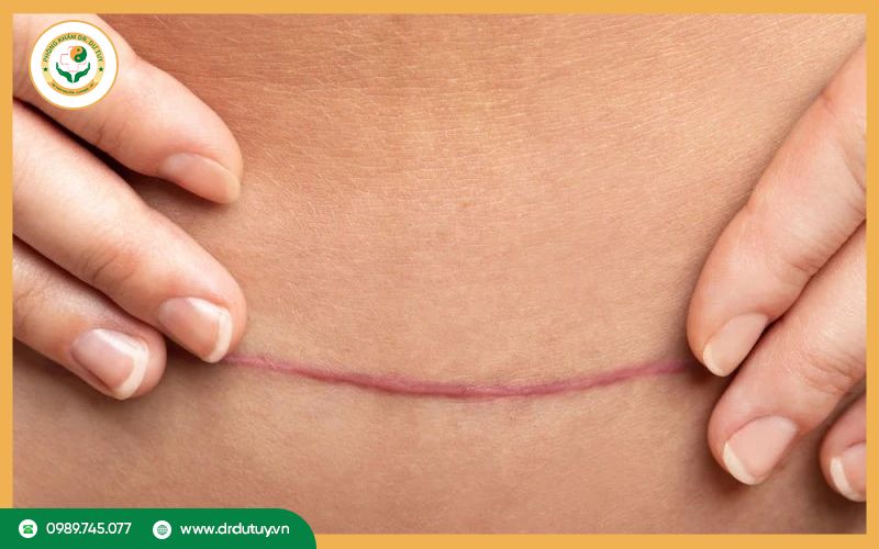 Tại sao vết mổ bị sưng cứng bên trong?