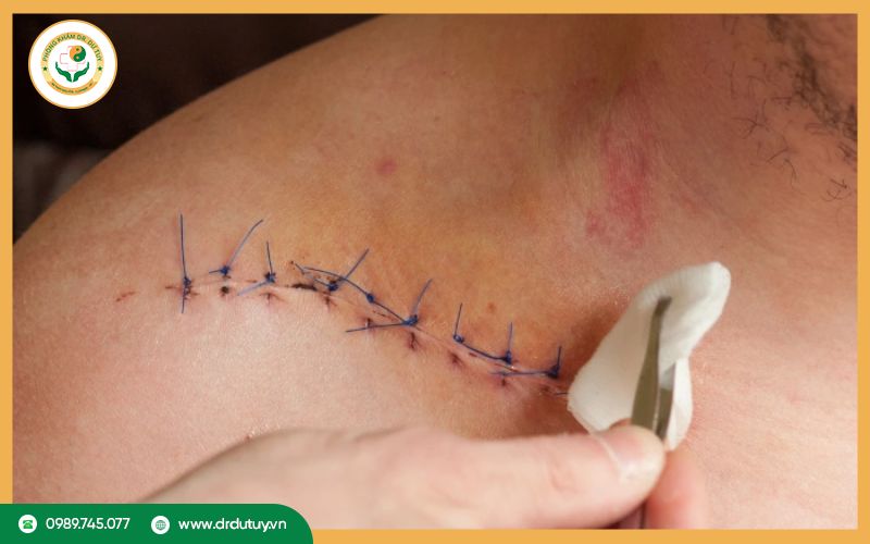 Tại sao vết mổ bị sưng cứng bên trong?