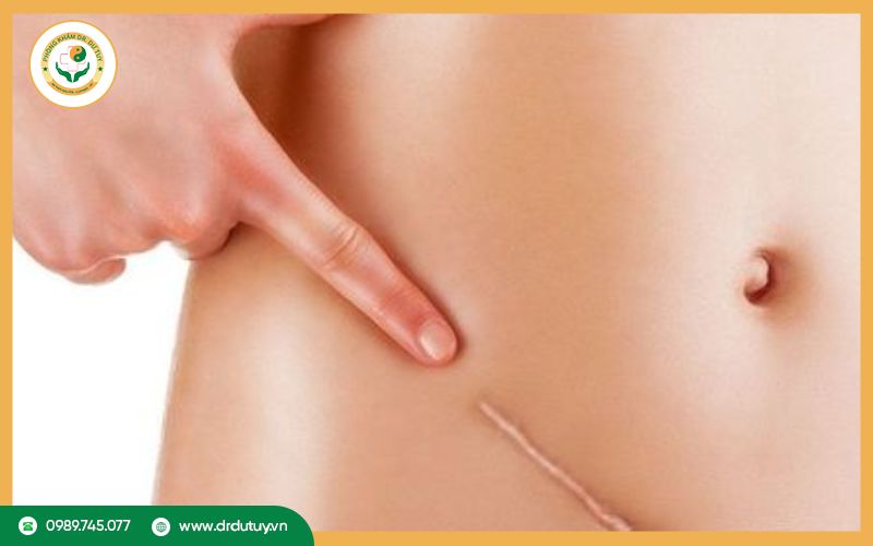 Vết mổ bị sưng cứng bên trong có sao không?
