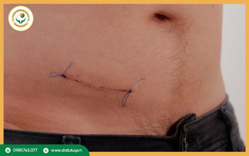 Cách xử lý khi gặp tình trạng vết mổ sưng cứng