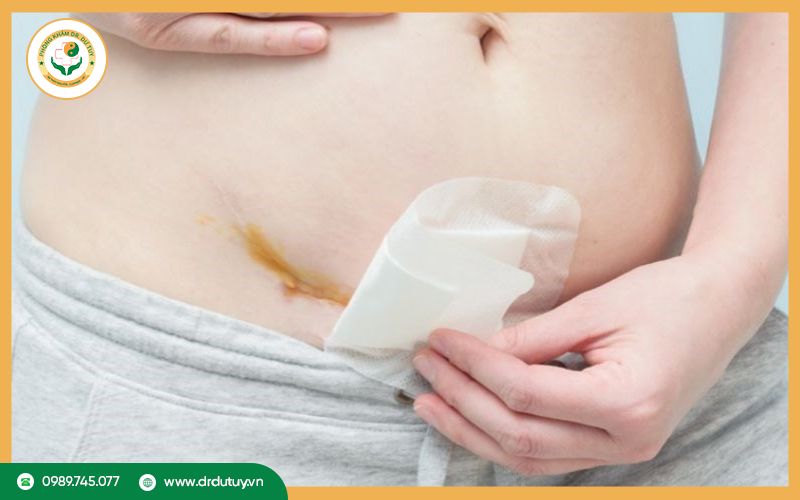 Hướng dẫn chăm sóc vết mổ bị sưng bên trong