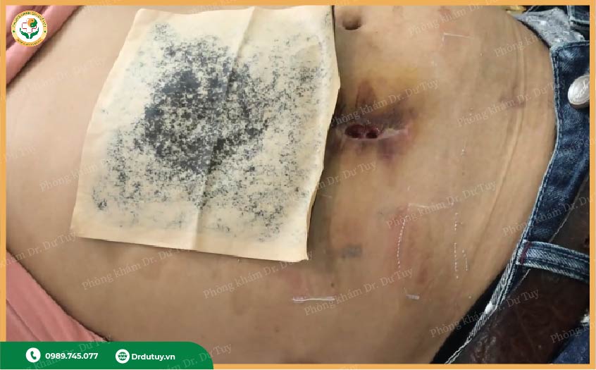 vết mổ hoại tử