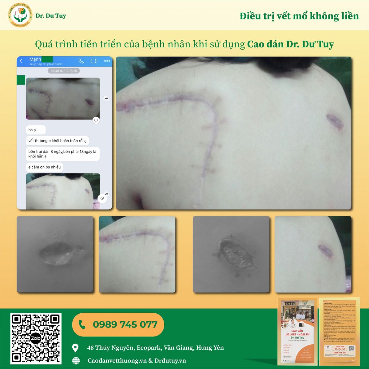 điều trị vết mổ không liền