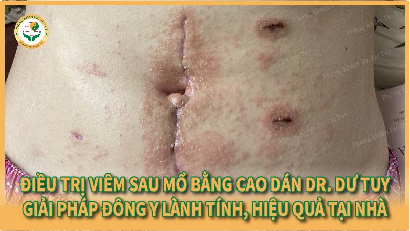 Điều trị viêm sau mổ bằng Cao dán Dr. Dư Tuy – Giải pháp Đông y lành tính, hiệu quả tại nhà