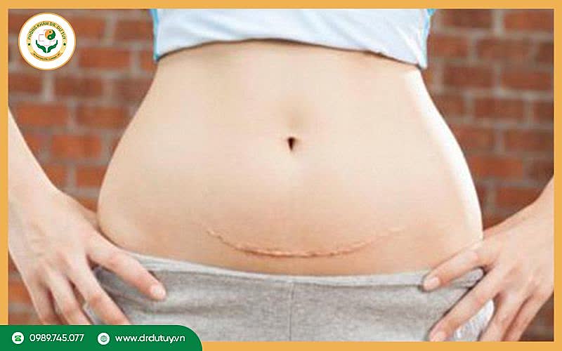 Vết mổ lấy thai: Những biến chứng thường gặp và cách xử lý
