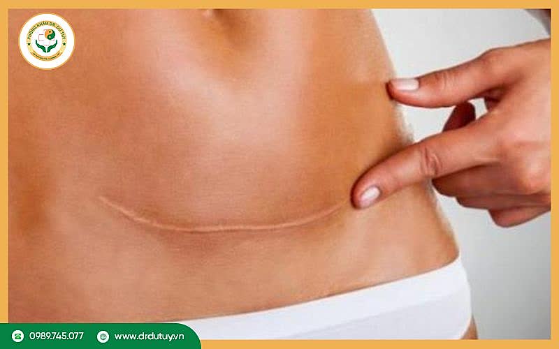 Vết mổ lấy thai là gì?