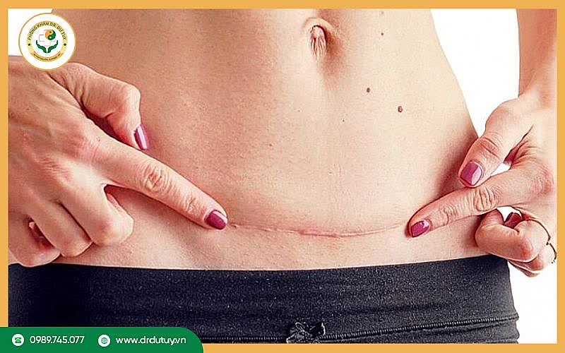 Các biến chứng sau mổ lấy thai