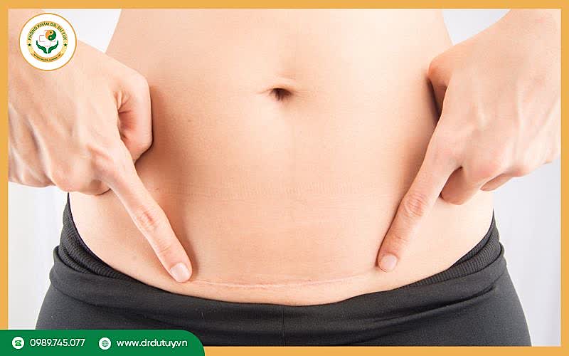 Các biến chứng sau mổ lấy thai