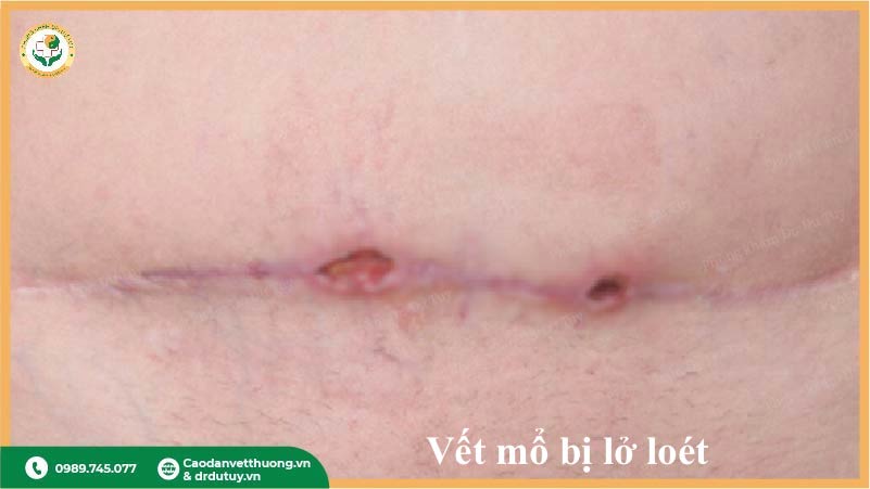 vết mổ sau phẫu thuật bị lở loét nhẹ