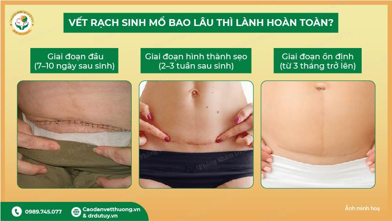 vết mổ sau sinh bao lâu thì lành