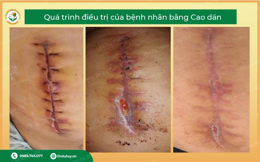 vết mổ sau sinh nhiễm trùng