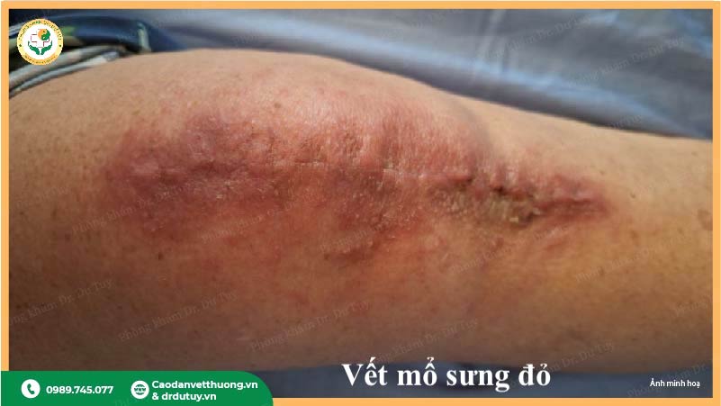 vết mổ sưng đỏ nhiễm trùng