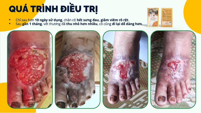 vết thương bàn chân đã lành hoàn toàn sau 1 tháng