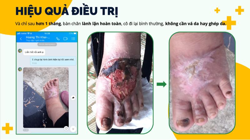vết thương bàn chân