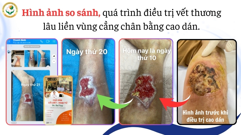 vết thương cẳng chân ngày 10, ngày 20