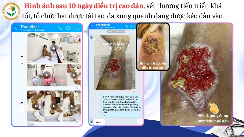 vết thương cẳng chân sau 10 ngày