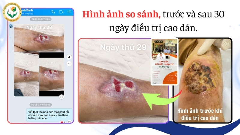 vết thương cẳng chân sau 30 ngày