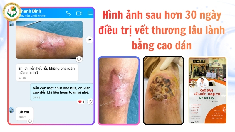 vết thương cẳng chân sau hơn 30 ngày
