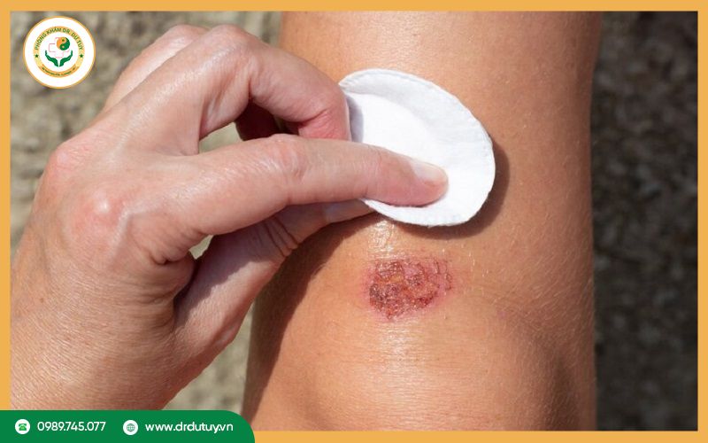 Nguyên nhân khiến vết thương hở chảy dịch vàng