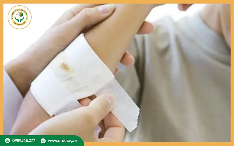 Cách xử lý khi có dịch vàng chảy ra từ vết thương