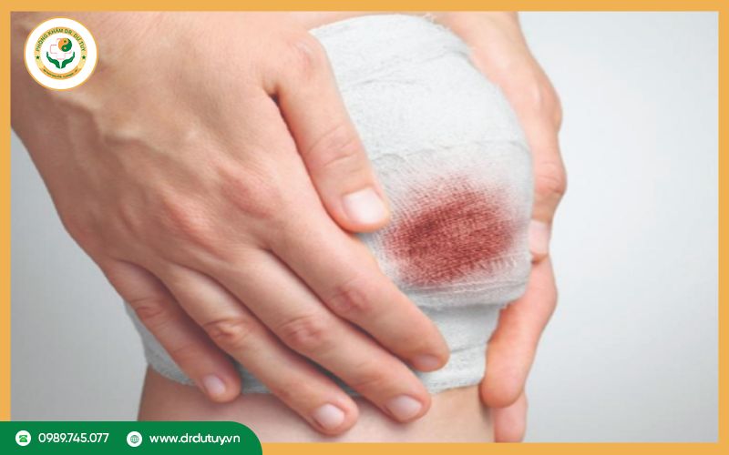 Dấu hiệu nhận biết vết thương hở có mùi hôi nguy hiểm