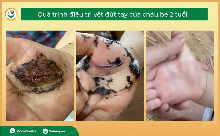 vết thương do dao ở trẻ em