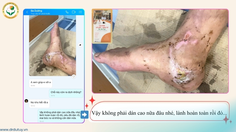 vết thương gót chân gần lành sau khi dùng cao dán