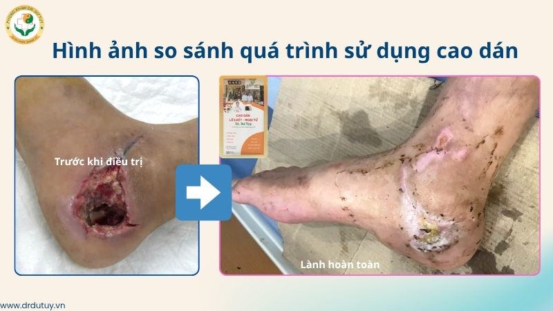 vết thương gót chân lành hoàn toàn sau điều trị cao dán
