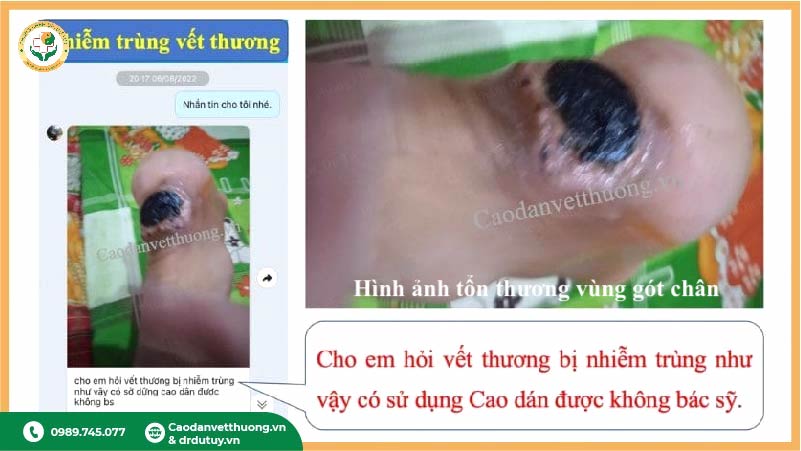 vết thương gót chân nhiễm trùng hỏi bác sĩ