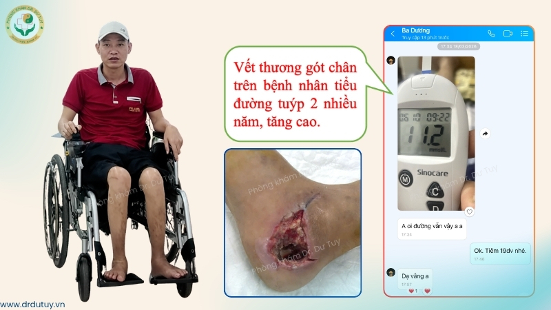 vết thương gót chân ở bệnh nhân tiểu đường tăng cao