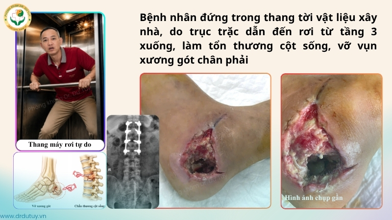 vết thương gót chân sau tai nạn rơi thang từ tầng 3