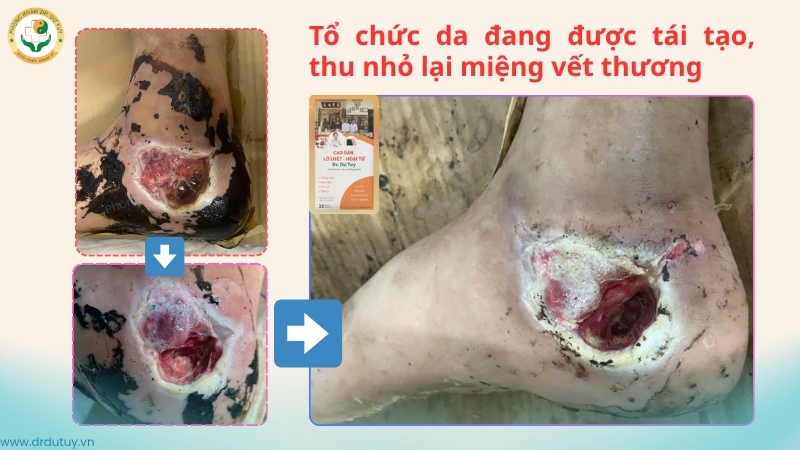 vết thương gót chân sinh tổ chức hạt thu nhỏ miệng thương