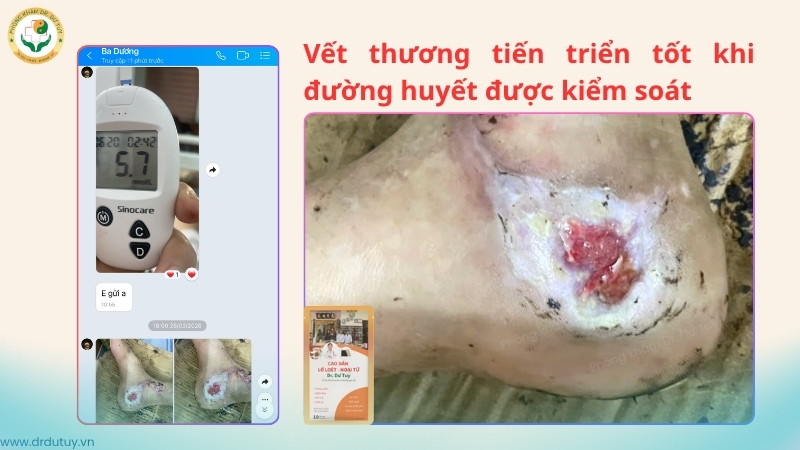 vết thương gót chân tiến triển tốt khi đường huyết ổn định