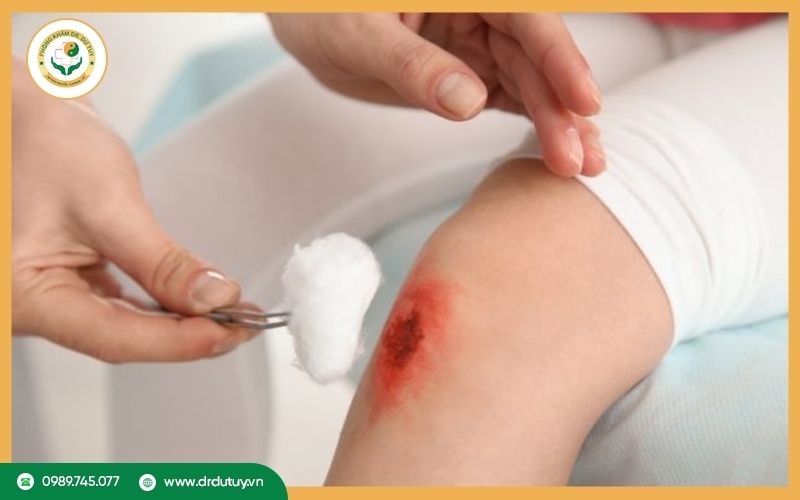 Cơ chế phục hồi của vết thương hở