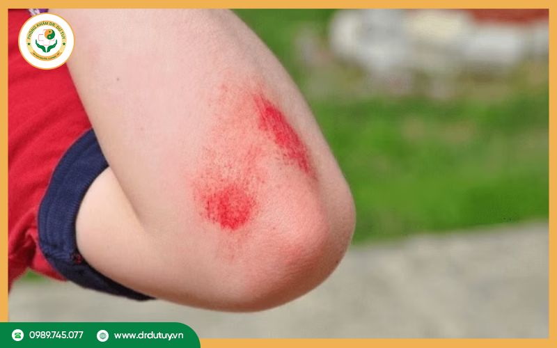 Bị vết thương hở tránh ăn gì để không bị sẹo?