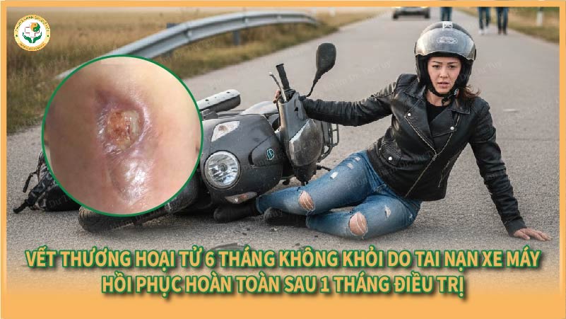 Vết thương hoại tử 6 tháng không khỏi do tai nạn xe máy – Hồi phục hoàn toàn sau 1 tháng điều trị