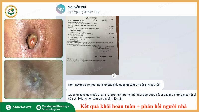 vết thương hoại tử khỏi hoàn toàn sau 1 tháng