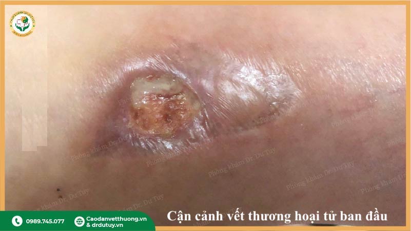 vết thương hoại tử lâu lành chi dưới