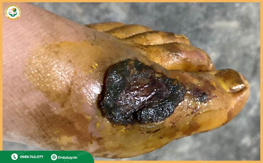 vết thương lâu lành, có mủ