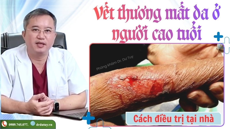 vết thương mất da ở người cao tuổi