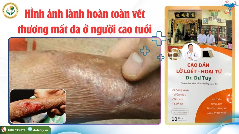 vết thương mất da sau hồi phục