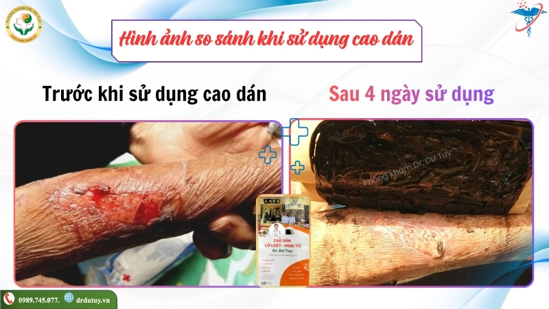 vết thương mất da trước sau 4 ngày